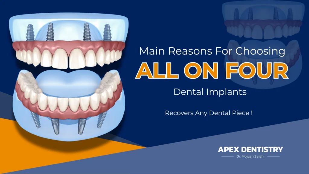 All-on-Four Dental Implants