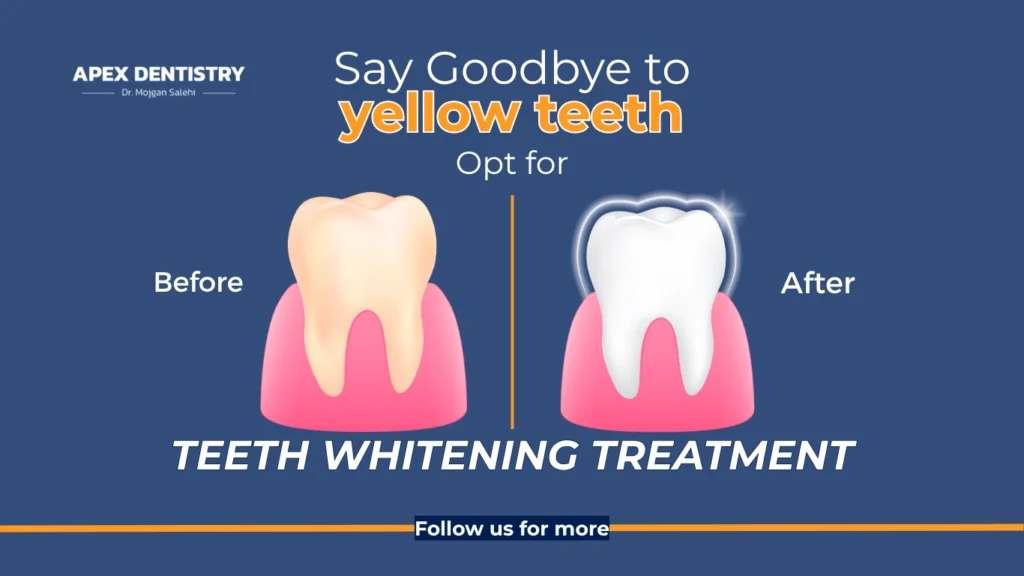 Apex_Teeth Whitening